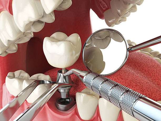 Best Emergency Wisdom Tooth Extraction in Woodmere, NY